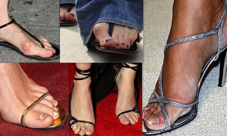 Tragic: Οι διάσημες και τα… απαίσια πόδια τους! (φωτό)