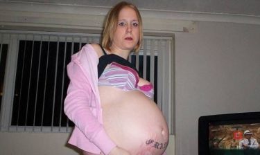 Σπάνια νόσος κάνει Βρετανίδα να μοιάζει έγκυος