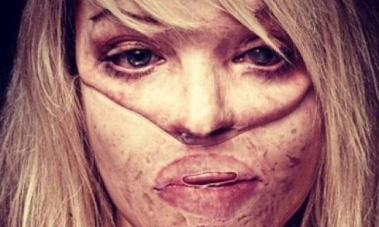 Η συγκλονιστική εξομολόγηση του πρώην μοντέλου, που δέχτηκε επίθεση στο πρόσωπο με οξύ