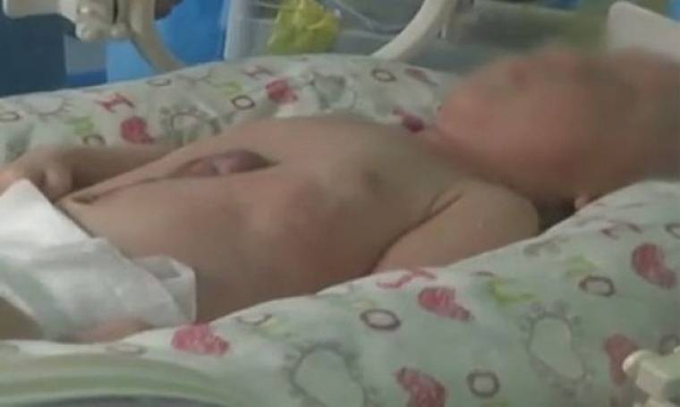 Συγκλονιστικό: Μωράκι γεννήθηκε με την καρδούλα του έξω από το σώμα του (βίντεο)