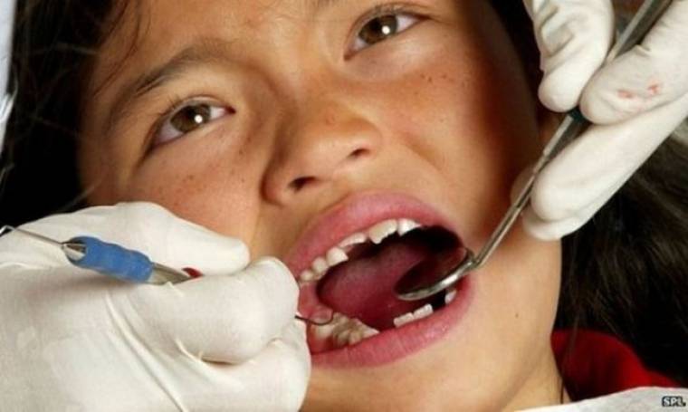 Τι είναι οι προληπτικές καλύψεις οπών και σχισμών των παιδικών δοντιών;