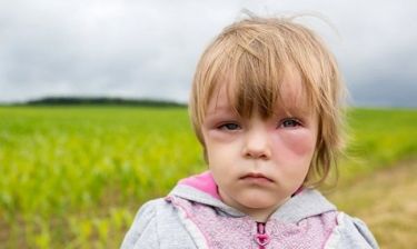 Αναφυλαξία στα παιδιά:Τι την προκαλεί, πώς αντιμετωπίζεται