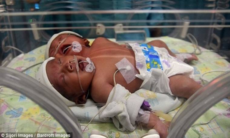 Μωρό με δύο κεφάλια γεννήθηκε στην Ινδονησία! (pics&vid)
