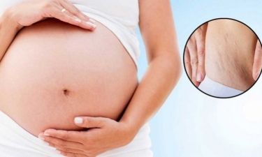 Τέσσερις τρόποι για να περιορίσετε τις ραγάδες του δέρματος κατά την εγκυμοσύνη
