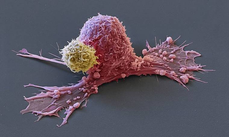 Μοναδικές φωτογραφίες αποτυπώνουν την επίθεση του οργανισμού ενάντια στα καρκινικά κύτταρα