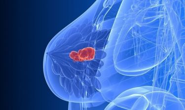 Καρκίνος μαστού & αϋπνίες: Η άσκηση που μετριάζει τα συμπτώματα