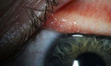 Δεν ξανάγινε! Γυναίκα φιλοξενούσε 14 μικροσκοπικά παράσιτα στο μάτι της (pics&vid)