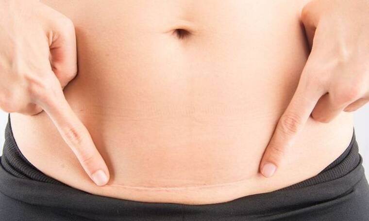 Καισαρική Τομή: Η προετοιμασία της εγκύου, οι επιπλοκές και το στάδιο της ανάρρωσης